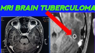 MRI BRAIN TUBERCULOMA CASE How to diagnose TUBERCULOMA in Mri Brain Tubercloma case [upl. by Smukler]