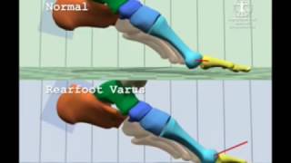 Comparison of Normal Gait to Rearfoot Varus Gait [upl. by Auqinaj]