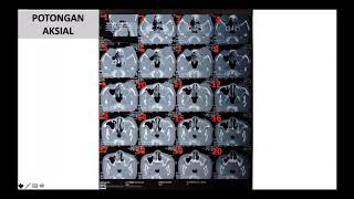 Pembacaan MSCT Scan Sinus Paranasal [upl. by Enier]
