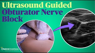 Ultrasound Guided Obturator Nerve Block [upl. by Dirk210]