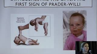 Diagnosing PraderWilli Syndrome [upl. by O'Connor]