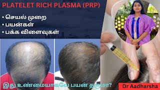 PRP treatment for Hair Loss  ஆண்களின் வழுக்கைமுடி உதிர்தலுக்கு PRP treatment  Procedure explained [upl. by Dnalhsa]