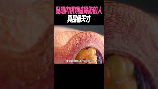 發明內視鏡縮胃術的人真是個天才科普 知識有趣 [upl. by Nalym]