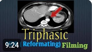 طريقة فحص مقطعية ثلاثية المراحل علي الكبد الجزء الثاني  CT triphasic liver part 2 [upl. by Dion]