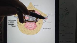 Spinal cord tumors Differences between Intra and Extramedullary lesions [upl. by Eliott916]