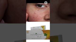 Melaglow Rich Cream Review In Hindi viralvideo ytshorts scars shorts youtubeshorts tips [upl. by Tihom]