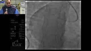 A case of heavily calcified LAD ostial and RCA stenosis Mirror Image Dextrocardia [upl. by Perretta975]