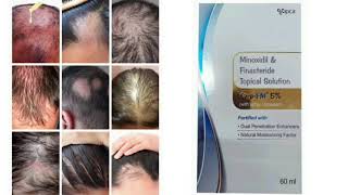 Karp FM 5 Topical Solution Minoxidil amp Finasteride Topical Solution [upl. by Rodnas]