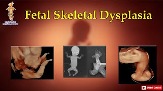 Fetal Skeletal Dysplasia [upl. by Enialahs]