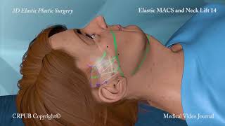 3D MACS and Neck Lift [upl. by Silvio415]