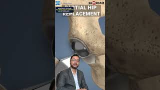 What is Partial Hip Replacement Hemi Replacement Surgery 🏥  Dr Debashish Chanda [upl. by Cesya]