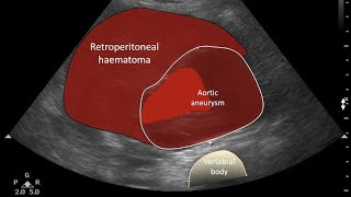 Abdominal Aortic Aneurysm Ultrasound [upl. by Okimuk475]