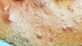 Extraction dacné kystique et pustule  cystic acne [upl. by Oiretule170]