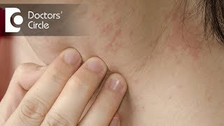 How to identify scabies rash amp its management  Dr Sudheendra Udbalker [upl. by Akiret]