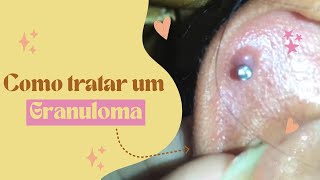 COMO TRATAR UM GRANULOMA NO PIERCING [upl. by Eiuol]