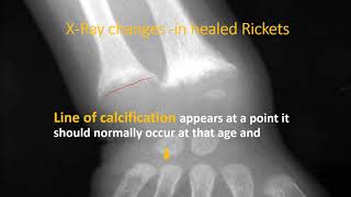 XRay wrist in rickets Part 23  Rickets  Pediatrics [upl. by Frasier]