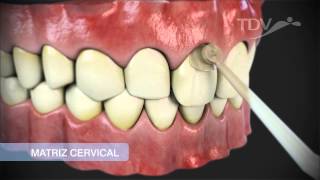 MATRIZ CERVICAL TDV  Restauraciones de Clase V [upl. by Dibbell327]