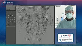 CTO Distal Aorta  LINC 2018 LC 2 LeipzigSchmidt  Tues 101pm [upl. by Fairfield]