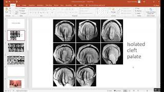 Orthodontics Cleft Lip and Palate Lecture 2 المرحلة الخامسة [upl. by Llennyl]