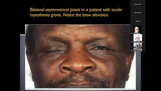 Approach to patient with diplopia [upl. by Eidaj667]