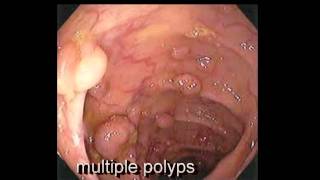 Colonoscopy FollowUp of Colon Polyp  Los Angeles Colonoscopy [upl. by Vale]