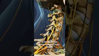 Anterior Cervical Discectomy and Fusion ACDF [upl. by Lilia]