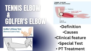 Tennis elbow amp Golfers elbow  Definition Causes Clinical features special test Pt management [upl. by Oneal245]