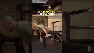 Quick tip ankylosingspondylitis arthritis sijoint Sacroiliitis [upl. by Crutcher]