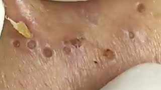 Blackheads amp Whiteheads Satisfying Removal 0066 [upl. by Darrey379]