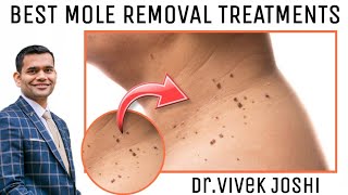 Effective Ways To Remove Moles Naturally  Every Thing about Removing Moles [upl. by Bathilda917]