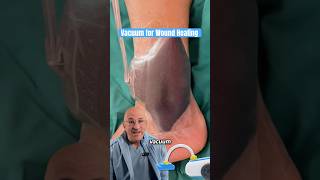 Wound Vac  Faster Healing amp Lower Infection Risk shorts [upl. by Ailat]