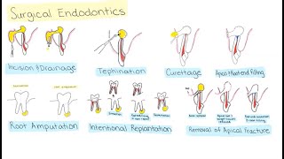 Surgical Endodontics [upl. by Eisoj]