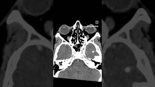 Case9 cect paranasal sinuses viral trending likesforlike commentsforcomments radiology [upl. by Raffaello]