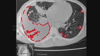 Pulmonary  Lung Metastasis • Radiology and Mechanism [upl. by Anerrol]