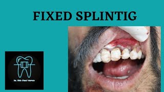 What Is Fixed Splinting   Trauma  dentist orthodontics dental [upl. by Mikey84]