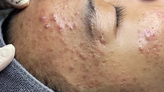 ACNE TREATMENT VU QUYNH MI  Perennial Blackheads On Boy Face 2024FULL [upl. by Yrelav98]