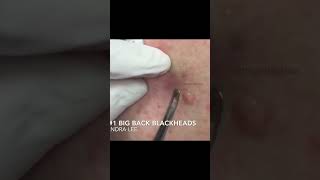 Dr Pimple Poppers Throwback Pops [upl. by Berlyn]