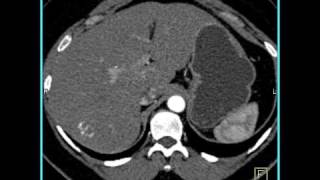 Abdomen Liver Hemangioma of the Liver1 of 8 [upl. by Editha]