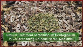 Our Natural Treatment of Molluscum Contagiosum in Children [upl. by Esaj]