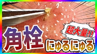 【角栓除去】超大量の”鼻の角栓”をにゅるにゅる圧出！【ブラックヘッドニキビ】／Blackhead Removal Show [upl. by Andrel768]