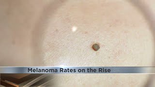 Melanoma rates are on the rise [upl. by Hsilgne]