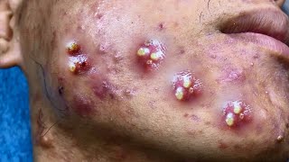 Big Cystic Acne Blackheads Extraction Blackheads amp Milia Whiteheads Removal Pimple Popping [upl. by Cristi476]