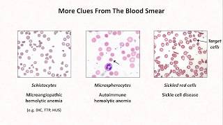 Hemoglobin BreakdownMetabolism [upl. by Kieger]