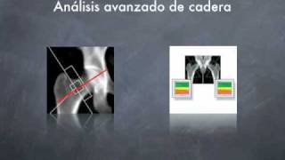 DIAGNOSTICO PRECOZ OSTEOPOROSIS [upl. by Ailecra]