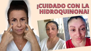 EFECTOS DE LA HIDROQUINONA 😱 UN TESTIMONIO SORPRENDENTE  ADRIANA VIEIRA [upl. by Nordin390]