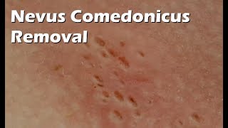 Nevus Comedonicus Removal  9 minutes worth [upl. by Yssenhguahs480]