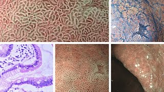 Intestinal metaplasia in stomach definition and types [upl. by Niatsirk]