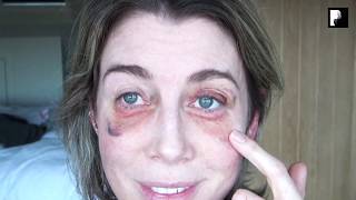 Blepharoplasty Video Diary  2 Weeks After Surgery 10 of 15 [upl. by Dub130]