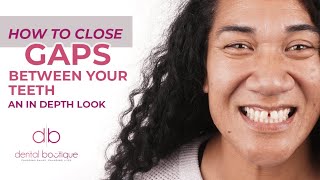 How To Close Gaps Between Your Teeth An In Depth Look  Dental Boutique [upl. by Yamauchi734]