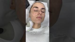 Amber Davies EndyMed Facial Tightening amp AgeJet Second Session at Dr MediSpa [upl. by Cahra923]